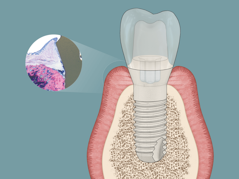 Grafik eines Querschnitts von einem Keramikimplantat