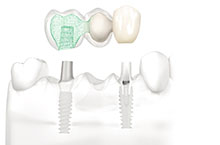 Zahnersatz auf Implantaten für zahnlose Patienten