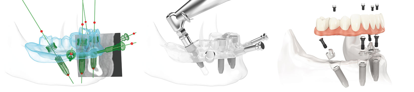 All-on-4®-Konzept im Unterkiefer: 3D- Planung und Einsetzen der 4 Implantate mittels Bohrschablone.  Dabei werden die beiden äußeren Zahnimplantate schräg, die beiden inneren gerade im Kieferknochen verankert.