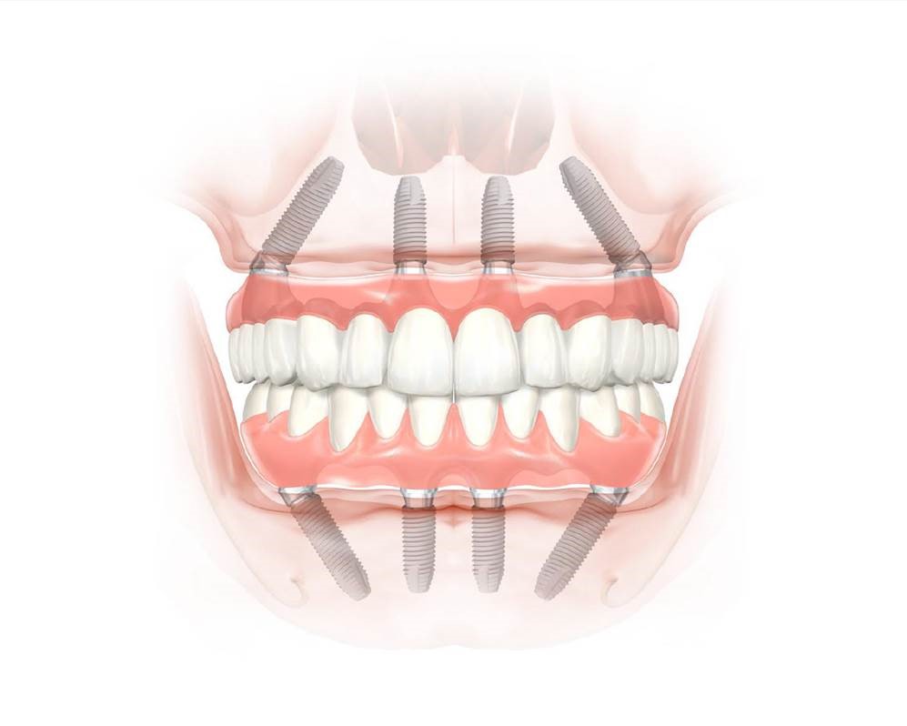 All-on-4® Behandlungskonzept: Versorgung des zahnlosen Ober- und Unterkiefers mit einer Brücke, die von jeweils 4 Implantaten getragen wird.