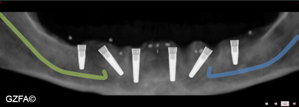 Versorgung des Unterkiefers mit sechs Implantaten nach 3D-Implantatplanung.