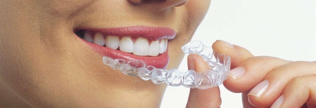 ALIGNER werden eingesetzt zur Korrektur von Zahnfehlstellungen.