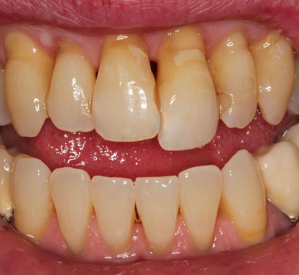 Gingivitis: Bakterielle Beläge im Oberkiefer sind der Auslöser für eine Zahnfleischentzündung und Zahnlockerung.