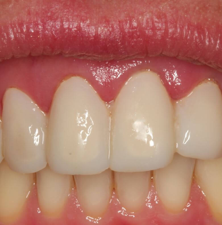 Gingivitis: Zahnfleischentzündung im Oberkiefer, im Unterkiefer dagegen ein rosafarbenes, gesundes Zahnfleisch.