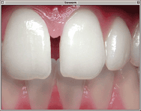 Wiederherstellung der Frontzahnästhetik: Schluss einer Frontzahnlücke (Diastema) mit zwei Veneers aus Keramik