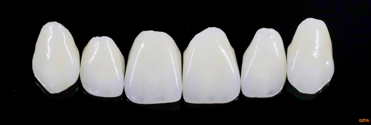 Prothetik-Sprechstunde: 6 Veneers aus Keramik im Oberkiefer.