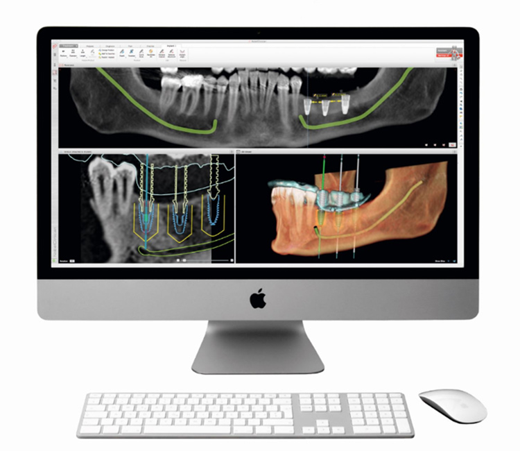 3D-Implantatdiagnostik mit dreidimensionaler Darstellung von Zähnen und Kieferknochen für die präzise und sichere Planung von Zahnimplantaten.
