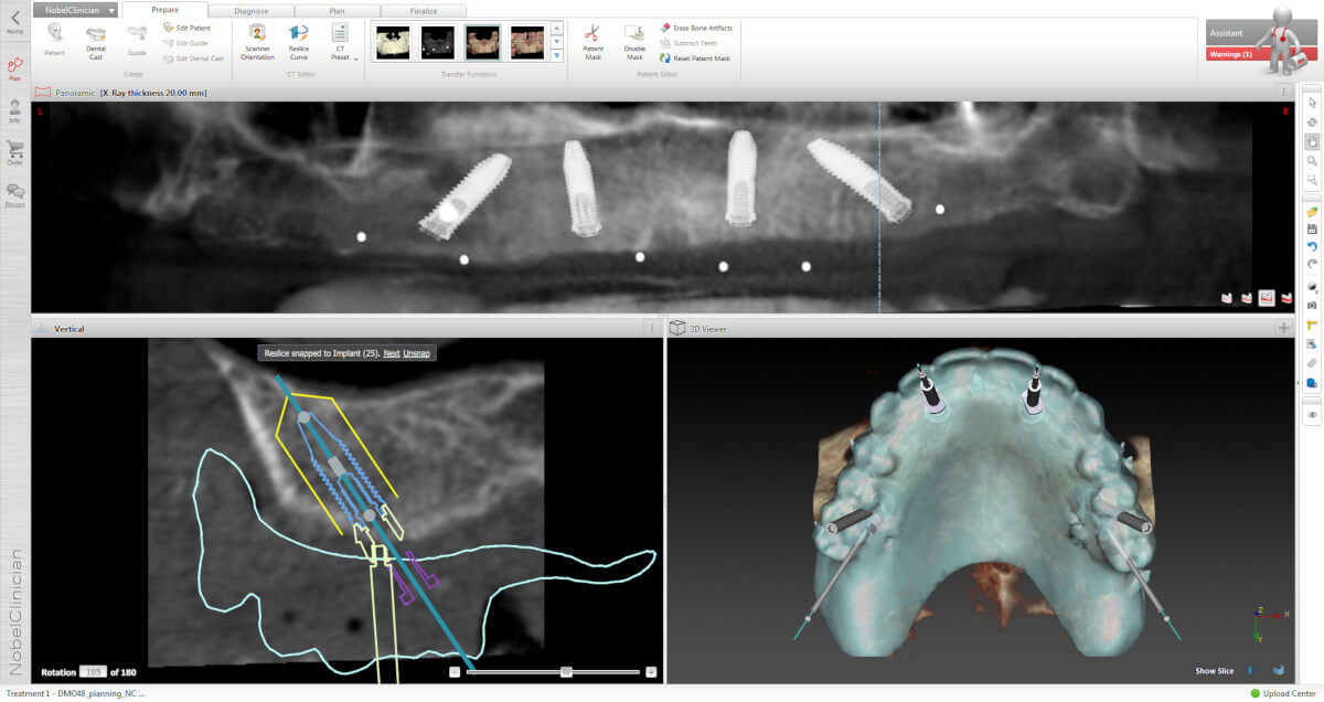 3D-Implantatplanung am Computer anhand von dreidimensionalen Röntgenbildern.