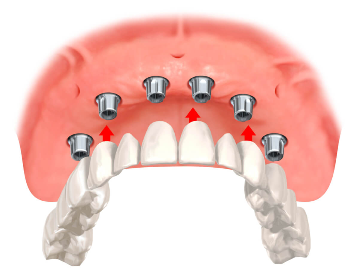 6 Implantate im Oberkiefer für festsitzenden Zahnersatz.