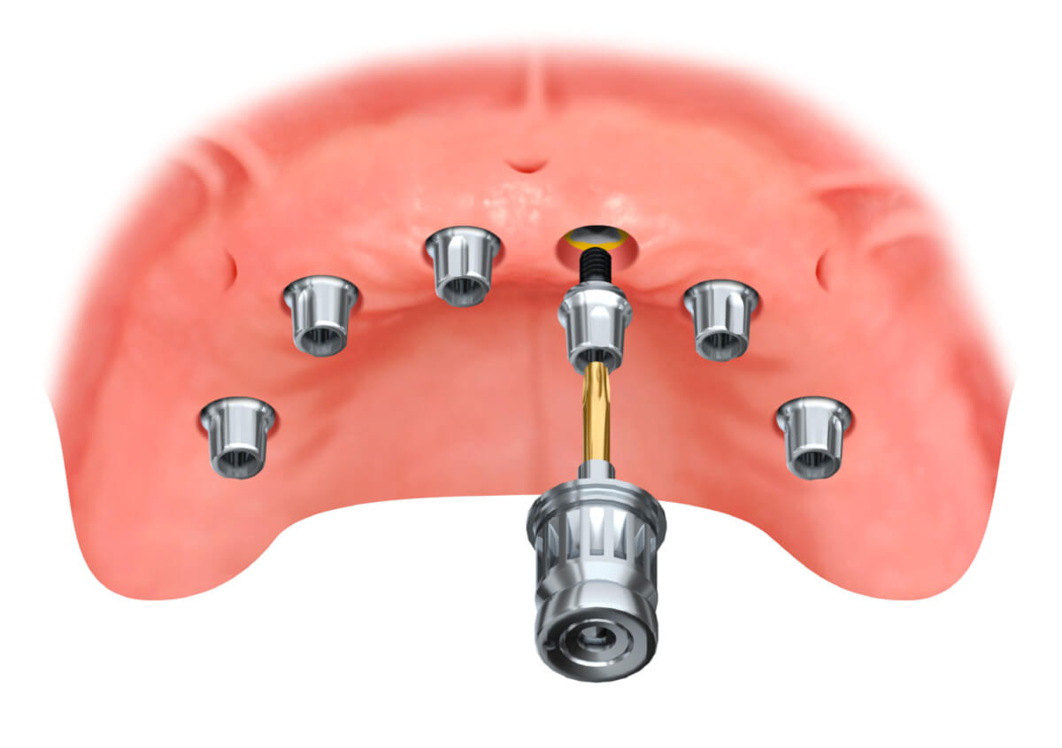 6 Zahnimplantate im Oberkiefer mit Aufbauten: Abutments - Verbindungselement zwischen Implantatschraube und Zahnkrone.