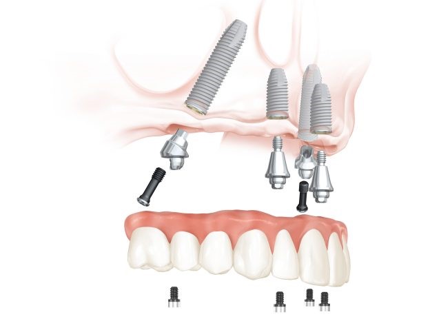 All-on-4® Behandlungskonzept im Oberkiefer: Zahnersatz auf 4 Implantaten.