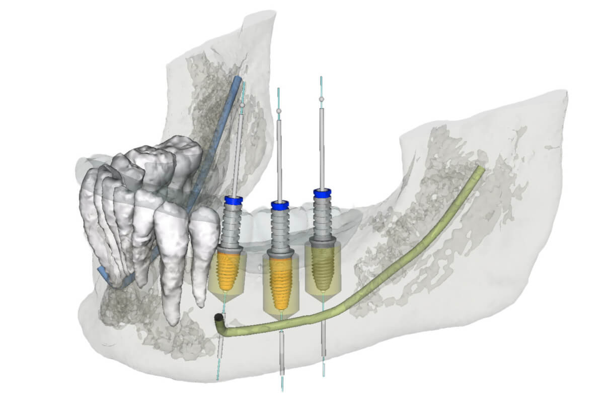 Backward-Planning: 3D-Planung der Positionierung von drei Implantaten mit Abutments und Zahnersatz - unter Berücksichtigung des Unterkiefernervs.
