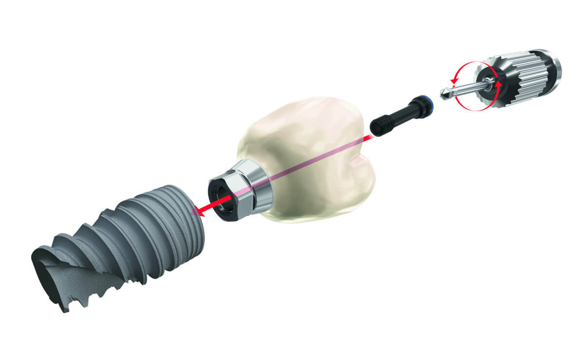 Implantatprothetik: Zahnimplantat und Abutment aus Titan, Zahnkrone aus Zirkonkeramik Implantatprothetik: Zahnimplantat und Abutment aus Titan, Zahnkrone aus Zirkonkeramik