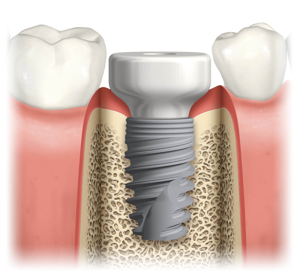 Der Längsschnitt durch den Unterkiefer zeigt die Implantatschraube mit Einheilkappe (Gingivaformer)&lt;br /&gt;Die Einheilung erfolgt durch die feste Verbindung der Implantatoberfläche mit dem Knochengewebe.