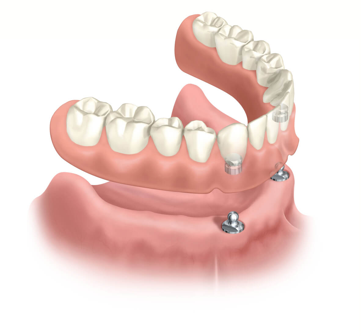 Mini-Implantate: Fester Halt für Zahnprothese im Unterkiefer auf 2 Implantaten
