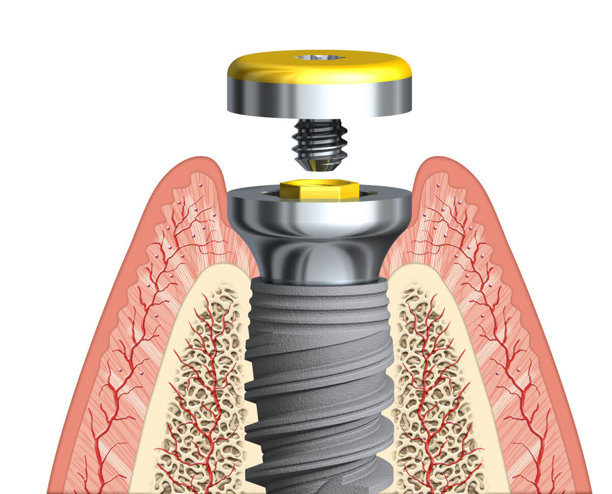 Periimplantitis: Wie entsteht eine Periimplantitis?
