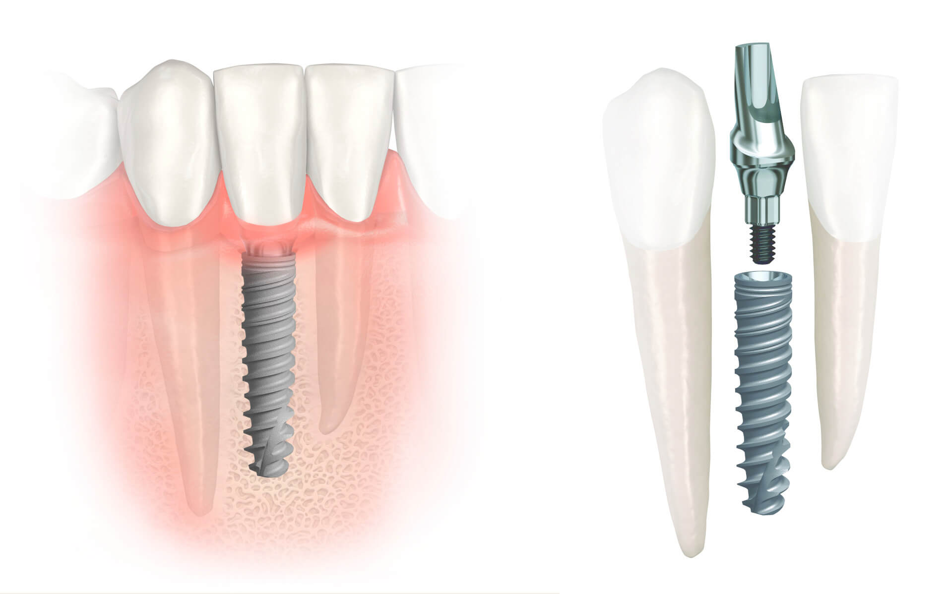Schmale Implantate: Idealer Lückenschluss in der Front