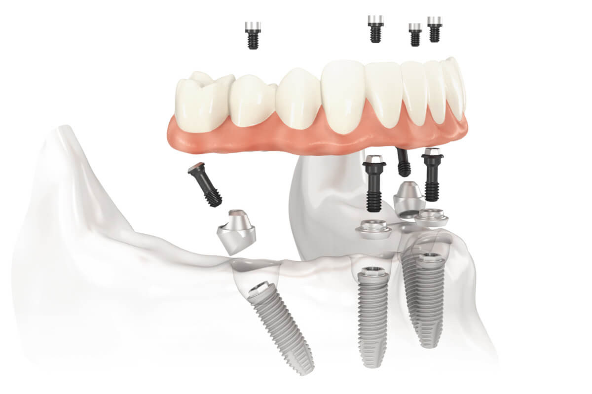 Suprakonstruktion als Prothese auf vier Implantaten verschraubt – All-on-4™ Konzept.