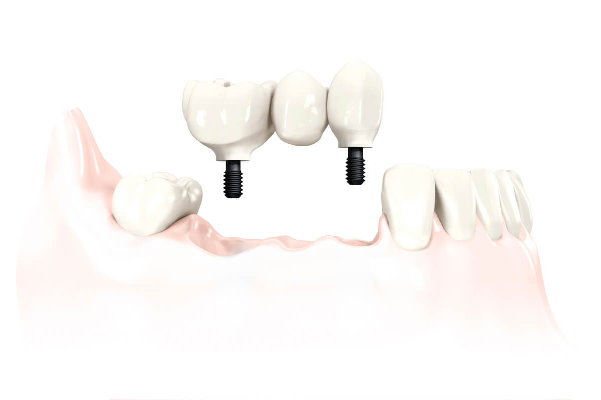 Suprakonstruktion als Brücke auf zwei Implantaten verschraubt.