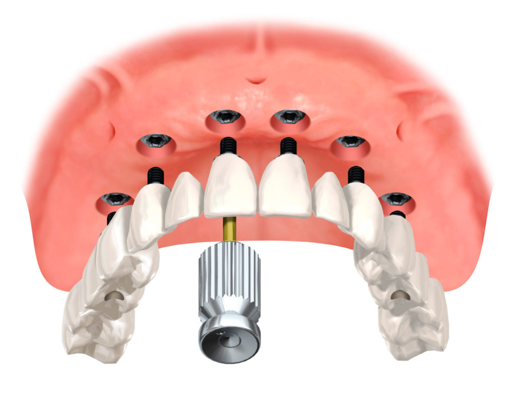 Verschraubter, festsitzender und funktioneller Zahnersatz auf 6 Implantaten im Oberkiefer.