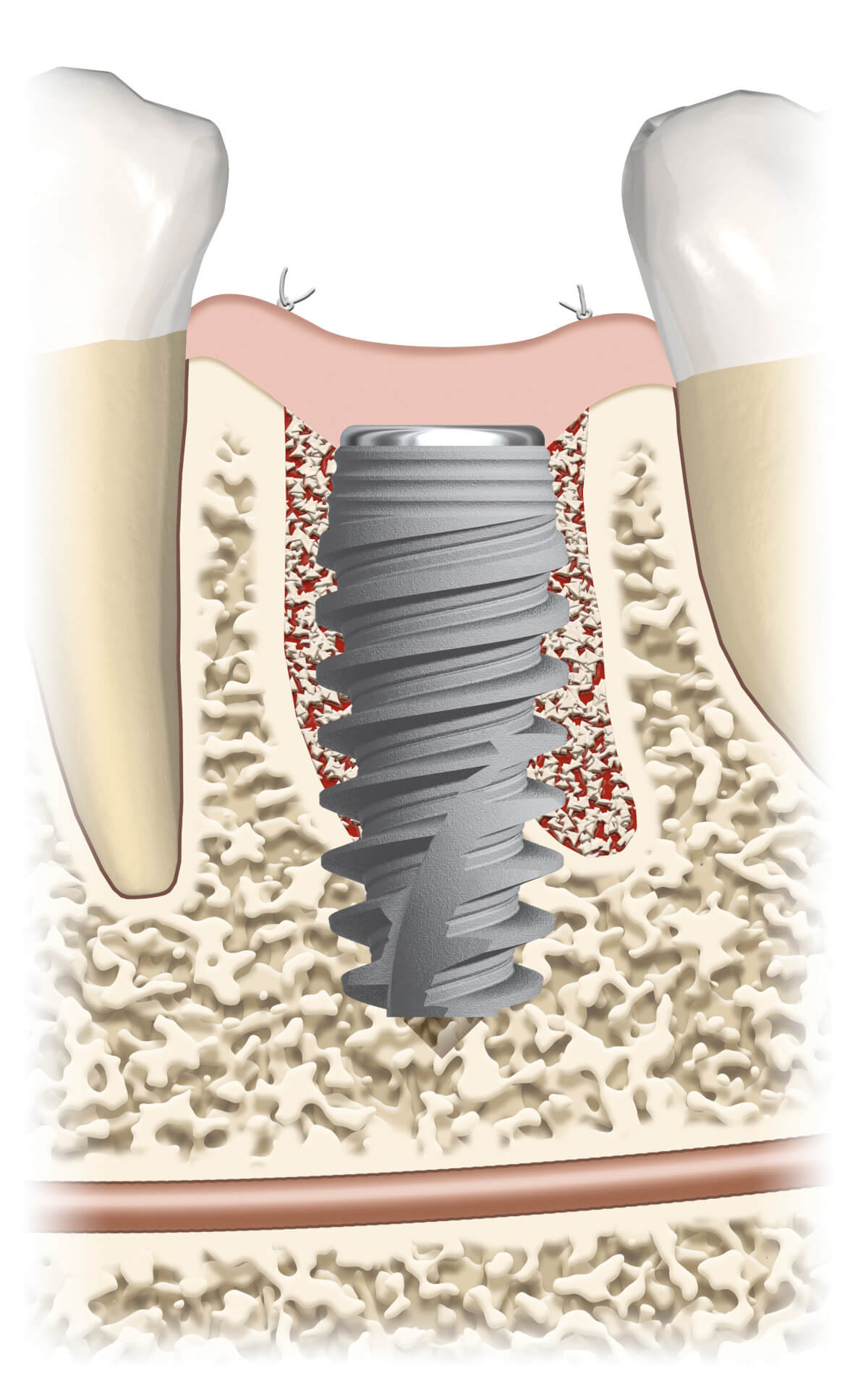 Zahnimplantat als Zahnersatz: Das Implantat, eine künstliche Zahnwurzel aus Titan oder Keramik.