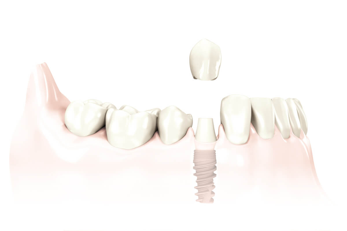 Zirkon-Abutment auf einem Zahnimplantat im Seitenzahnbereich mit Keramikkrone
