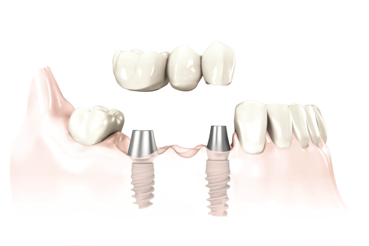 Zirkonbrücke auf 2 Implantaten im Unterkiefer.