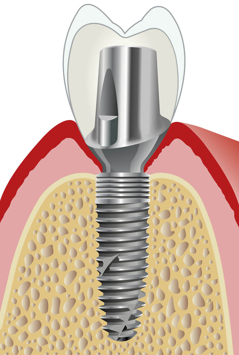 Individuelle Implantatprothetik mit Platform Switch für BEGO Semados® RS/RSX-Implantate.