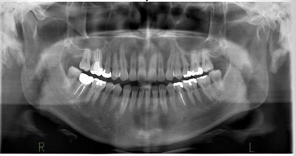 OPG – Orthopantomogramm: Die Röntgenübersichtsaufnahme erlaubt die Beurteilung von Zähnen, Kieferhöhlen und Kieferknochen und dient als Basis für die Implantatplanung.