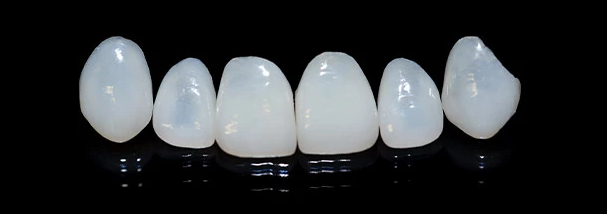 Ein Bild von natürlichen funktionellen Keramik-Veneers aus Presskeramik, die hochästhetische Verblendschalen sind