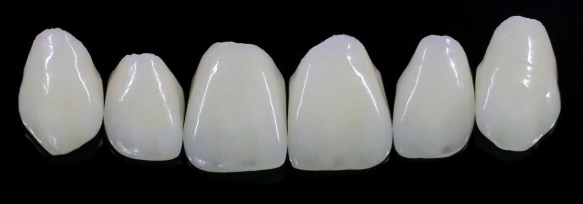 Zahnzusatzversicherung für Veneers: 6 Veneers (Keramische Verblendschalen) für den Oberkiefer.