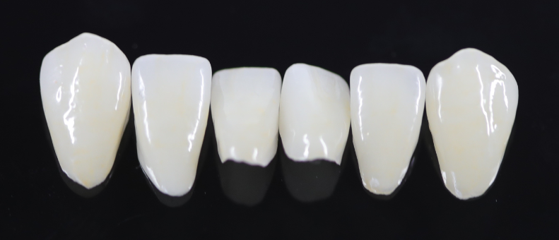Zahnzusatzversicherung für Veneers: 6 Veneers (Keramische Verblendschalen) für den Unterkiefer.