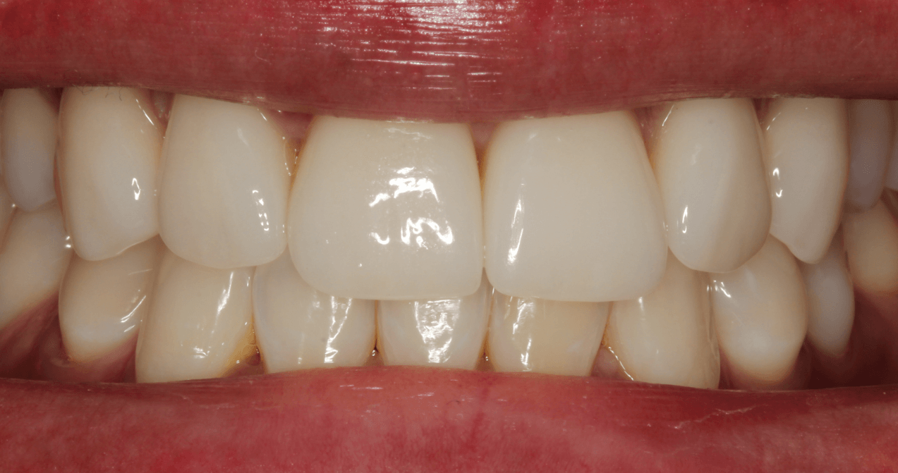 Ästhetisch perfekte Zahnersatzversorgung aus dem deutschen Meister-Dentallabor.