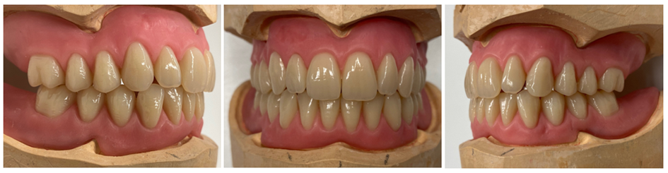 Mithilfe der Funktionsdiagnostik gelingt eine neue Auf- und Fertigstellung von Ober- und Unterkiefer 
mit 6 mm Bisshebung – Funktion und Ästhetik sind wieder hergestellt!
Bildquelle: ©GZFA
 