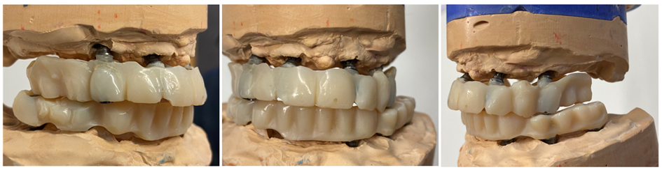 Ausgangssituation: Langzeitprovisorien aus Kunststoff auf Implantaten, 6 mm vertikaler Substanzverlust.
Bildquelle: ©GZFA
 