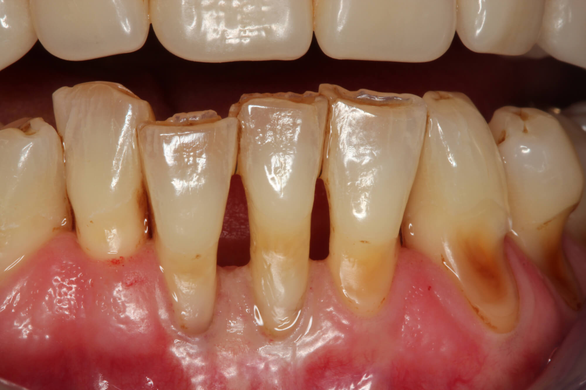 Halitosis-Praxis: Mundgeruchbehandlung beim Zahnarzt, wenn der schlechte Atem von den Zähnen kommt.