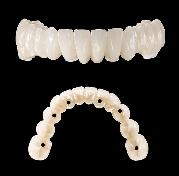 Alle zahntechnischen Arbeiten wurden im Labor König & Weiß Dentaltechnik in München hergestellt.