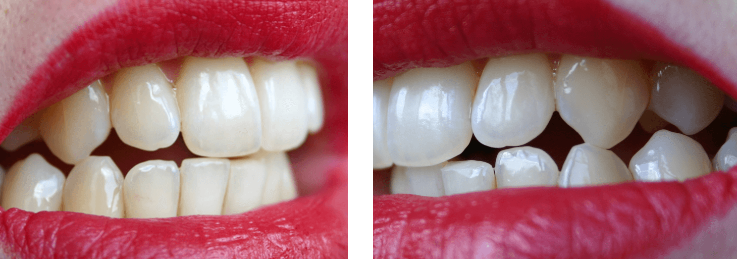 Veneer-Sprechstunde: Keramikschalen für perfekte Zahnästhetik.