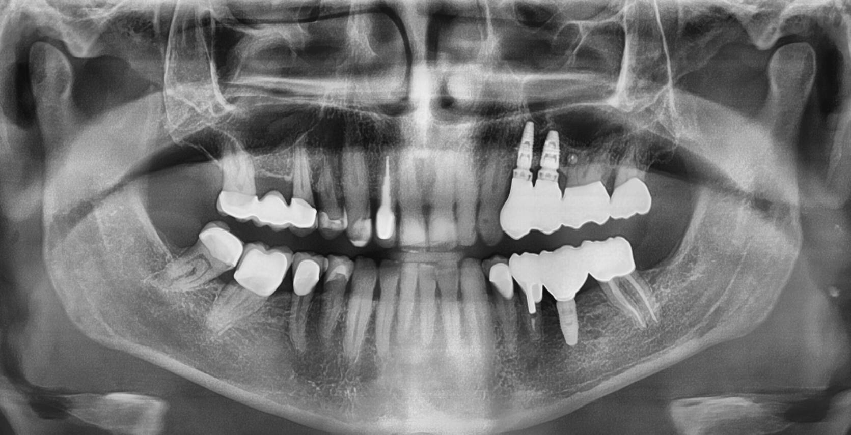 Neuimplantation von zwei Zahnimplantaten im Oberkiefer, verbunden mit aufwändigem Knochenaufbau und hohen Kosten.