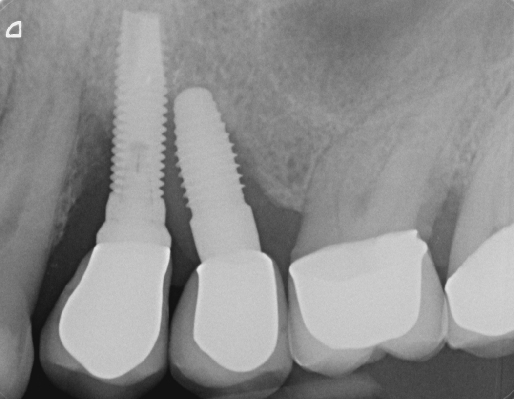 Mangelhaft gesetzte Zahnimplantate im Oberkiefer - Folge: Knochenrückgang mit Verlust beider Implantate.