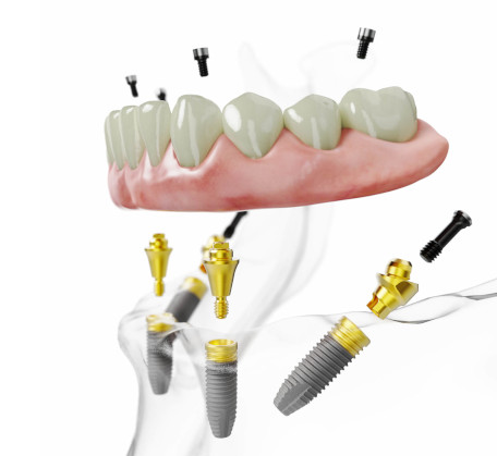 Zahnzusatzversicherung für Feste Zähne an einem Tag – Das All-on-4® Behandlungskonzept.