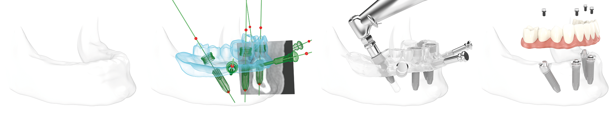 All-on-4® Behandlungskonzept im Unterkiefer: Die beiden äußeren Zahnimplantate werden schräg, die beiden innen liegenden Implantate gerade in den Kieferknochen eingesetzt. Mit vier kleinen Schrauben wird darauf eine Zahnbrücke aus Kunststoff fest montiert.