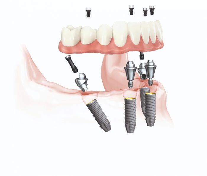 Klinik-Sprechstunde: Sofortversorgung bei totalem Zahnverlust mit dem All-on-4® -Behandlungskonzept.