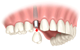 Zahnlücke mit Implantat und Zahnkrone