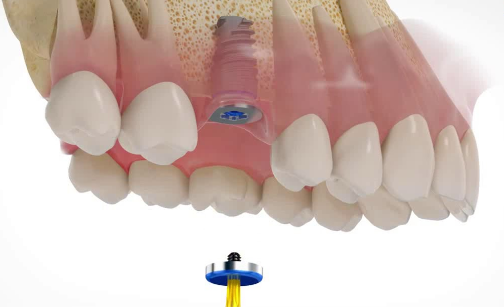 Vermeidung von Implantatverlust durch richtige Positionierung des Zahnimplantats.