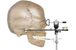 Anlegen des Gesichtsbogens an den anatomischen Schädelstrukturen.
