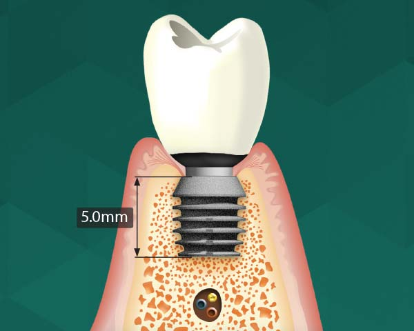 BICON Implantatsystem: Implantate ohne Schrauben