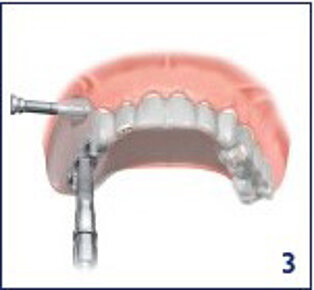 Implantation Implantation