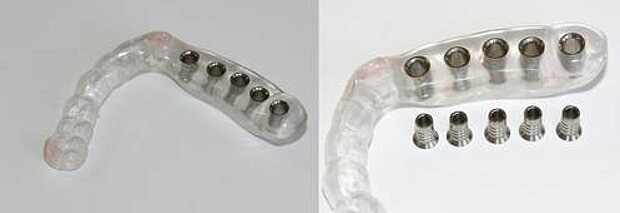  Unterkiefer-Bohrschablone für 5 Implantate