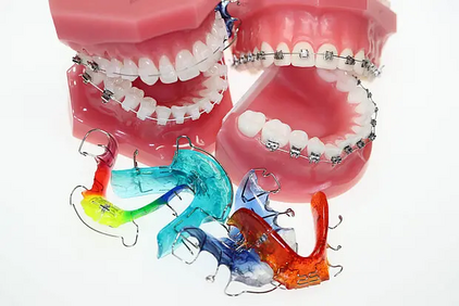 Ein Bild mit verschiedenen Zahnspangen und Brackets